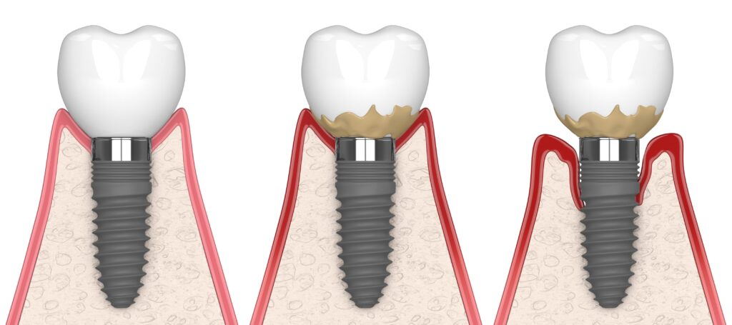 Peri Implantitis - Al-Fa Perio Clinic