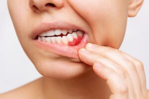 Bleeding Gums - Al-Fa Perio
