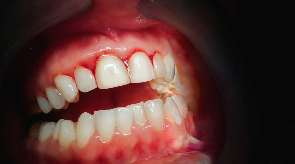 What is periodontitis? Al-Fa Perio Clinic