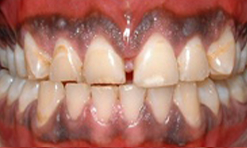 Crown Lengthening A - After