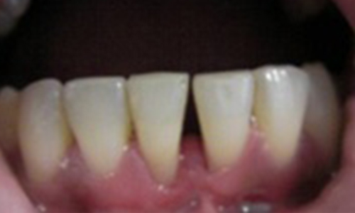 Frenectomy With Laser A - After