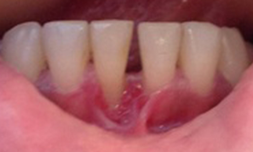 Frenectomy With Laser A - Before
