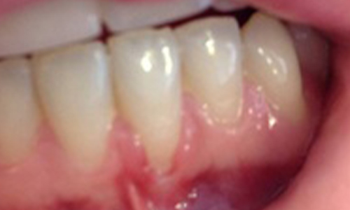 Frenectomy With Laser B - Before