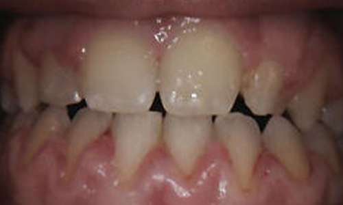 Gingival Contouring Before - Al-Fa Perio