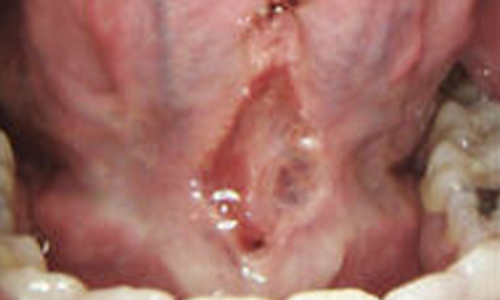 Laser Frenectomy Before - Al-Fa Perio