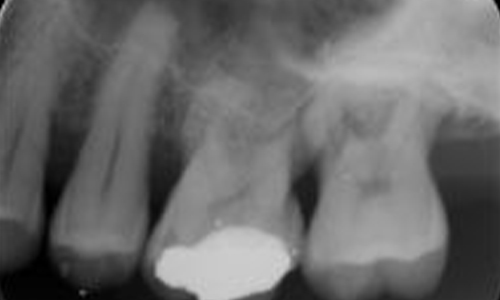 Laser Regeneration A- After- Al-Fa Perio