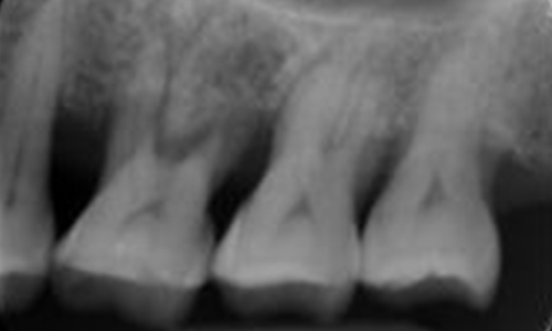 Laser Regeneration B - After - Al-Fa Perio