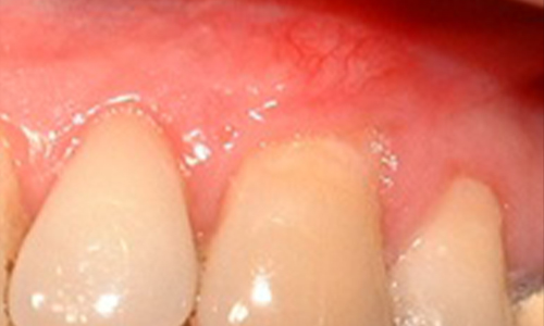 Localised Gingival Recession - After
