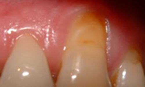 Localised Gingival Recession - Before