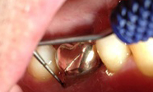 Non-surgical Laser Regeneration B, During - Al-Fa Perio