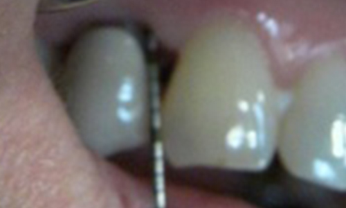 Periodontal Therapy - After- Al-Fa Perio