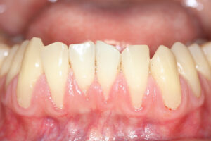 Receding gum treatment - Al-Fa Perio Clinic