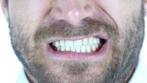 Receding gums treatment - Al-Fa Perio Clinic