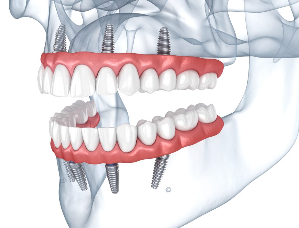 Prostheses,Supported,By,8,Implants.,Dental,3d,Illustration All-on-4 Implants Essex