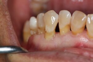 Periodontal disease stages - Al-Fa Perio Clinic