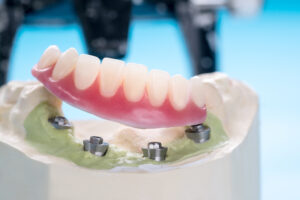Closeup/,Dental,Implants,Supported,Overdenture,On,Blue,Background/,Screw,Retained/ Dental Implants Essex - Al-Fa Perio Clinic