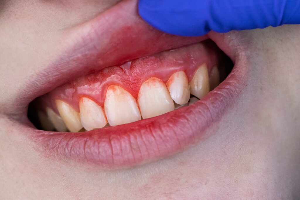 Periodontitis,.,Periodontitis,Is,Often,Known,As,'gum,Disease',And Periodontal disease treatment - Al-Fa Perio Clinic