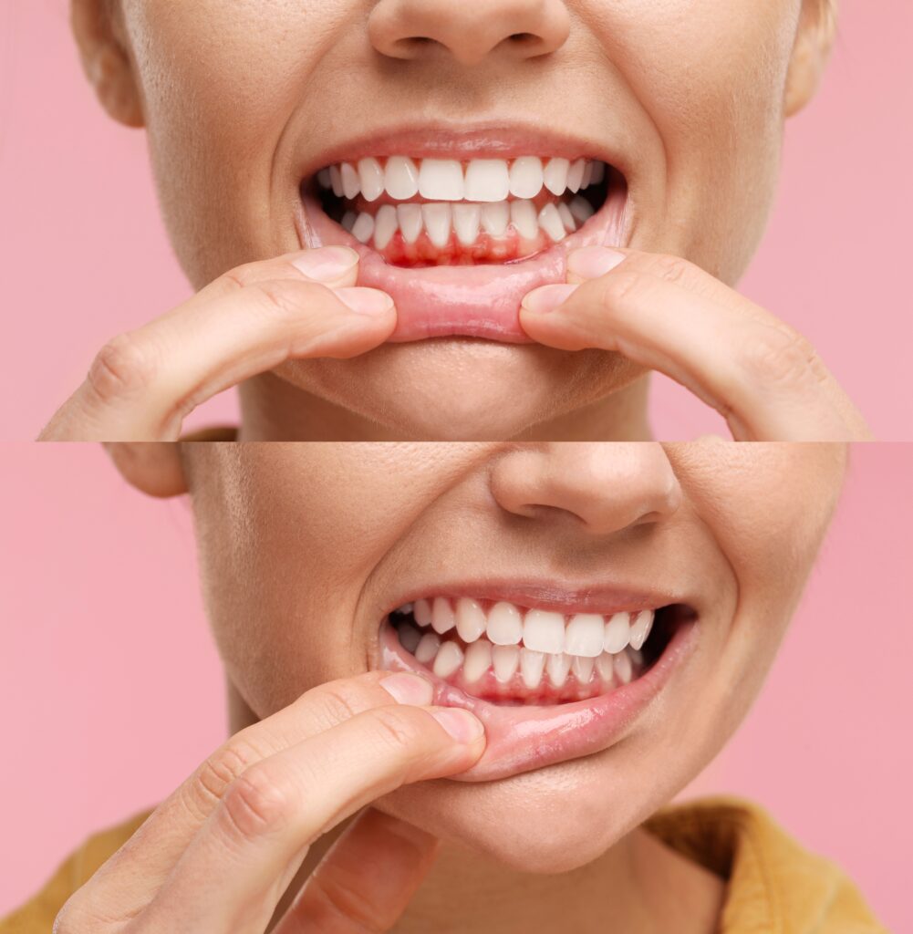 Laser gum treatments - Al-Fa Perio Clinic